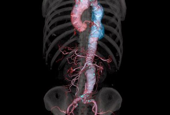 血管の三次元画像