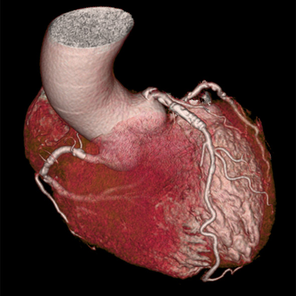 心臓（冠動脈）造影CT